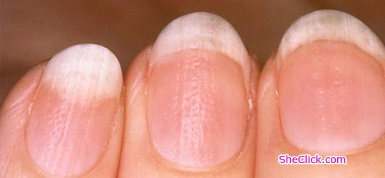 How to Treat Cracked Nails | HowStuffWorks